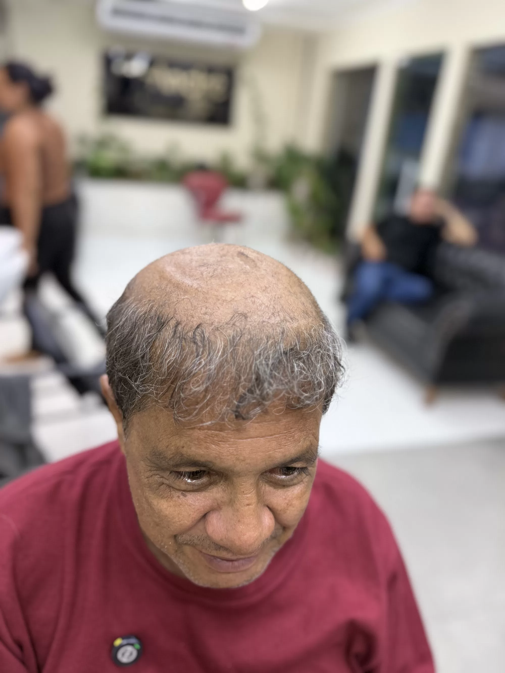 Antes — Cabelo grisalho, cheio e natural para quem já tinha pouco cabelo: prótese capilar masculina que ninguém percebe.