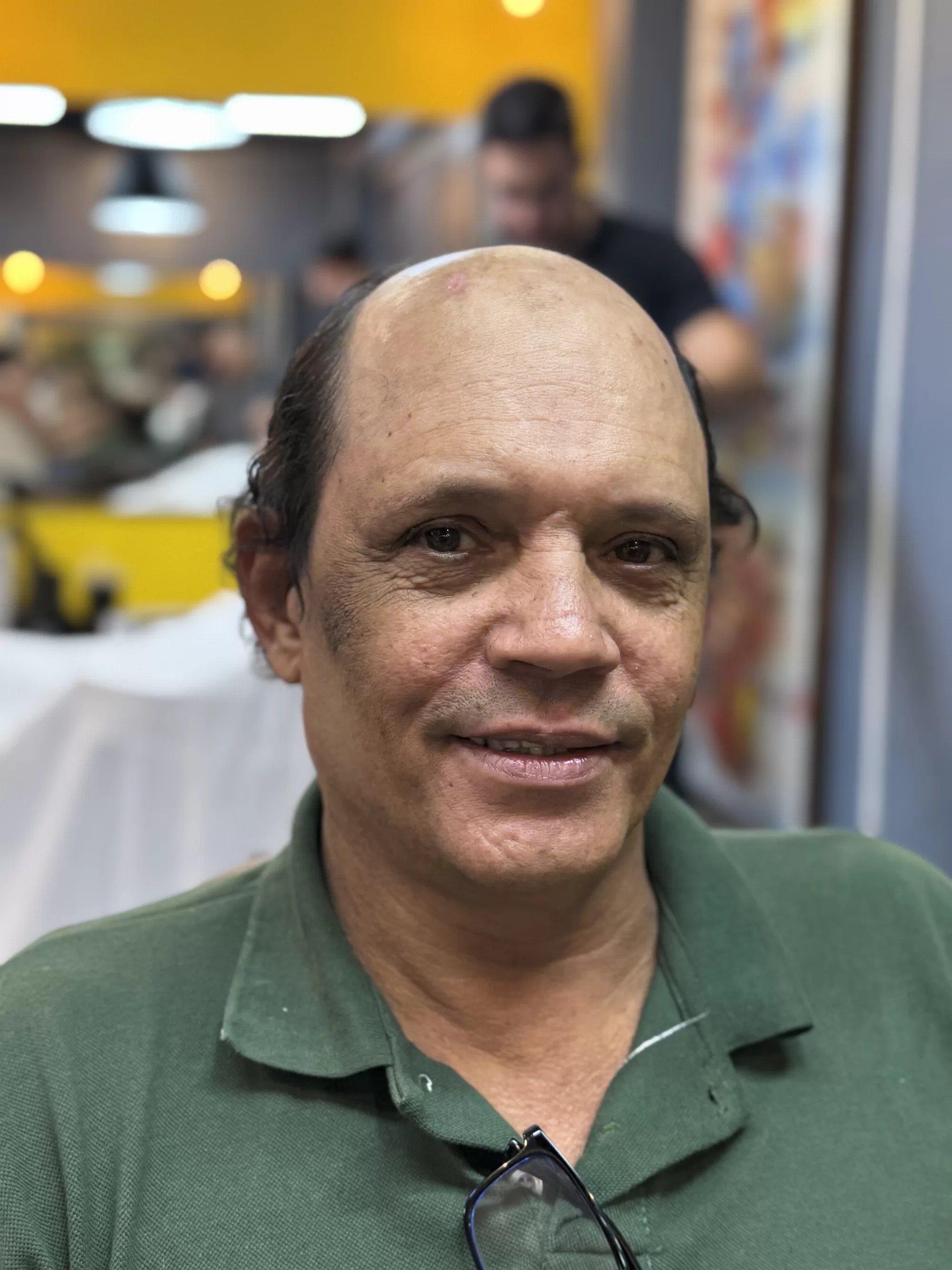 Antes — Disfarçou as entradas e a careca do topo com cabelo que parece de verdade: prótese capilar masculina na hora, sem cirurgia.