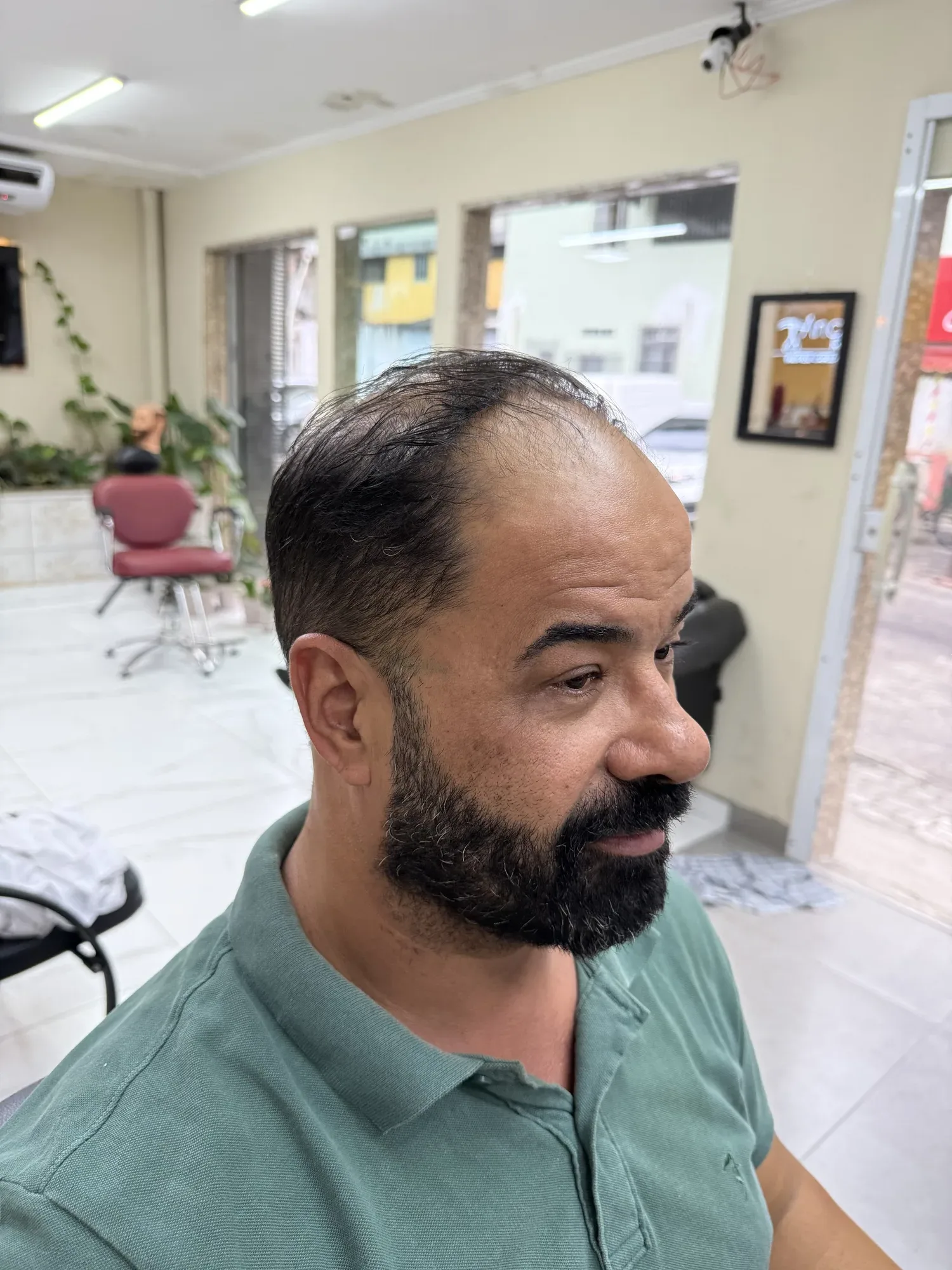 Antes — Estava ficando careca no topo e voltou a ter cabelo cheio: prótese capilar masculina natural, com resultado na hora. Estúdio André Ricci.