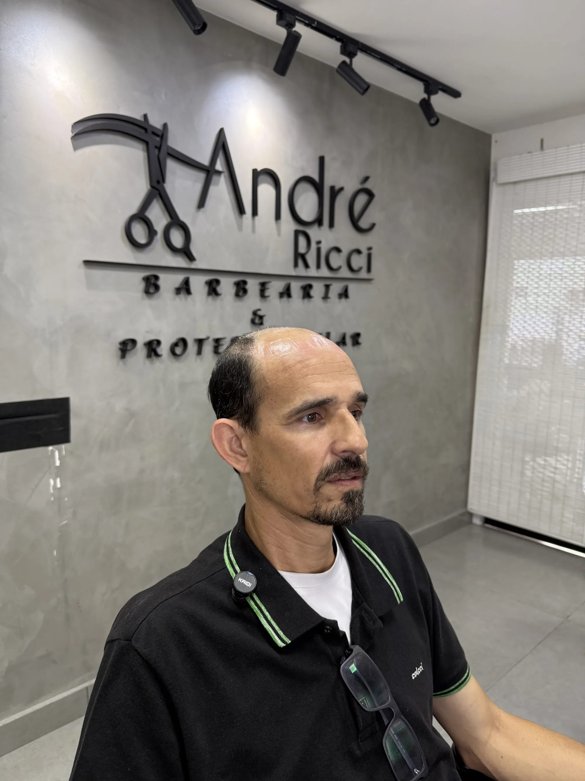 Antes — Cobriu a calvície da frente com prótese capilar masculina: cabelo natural, discreto e que ninguém percebe. Magé/RJ.