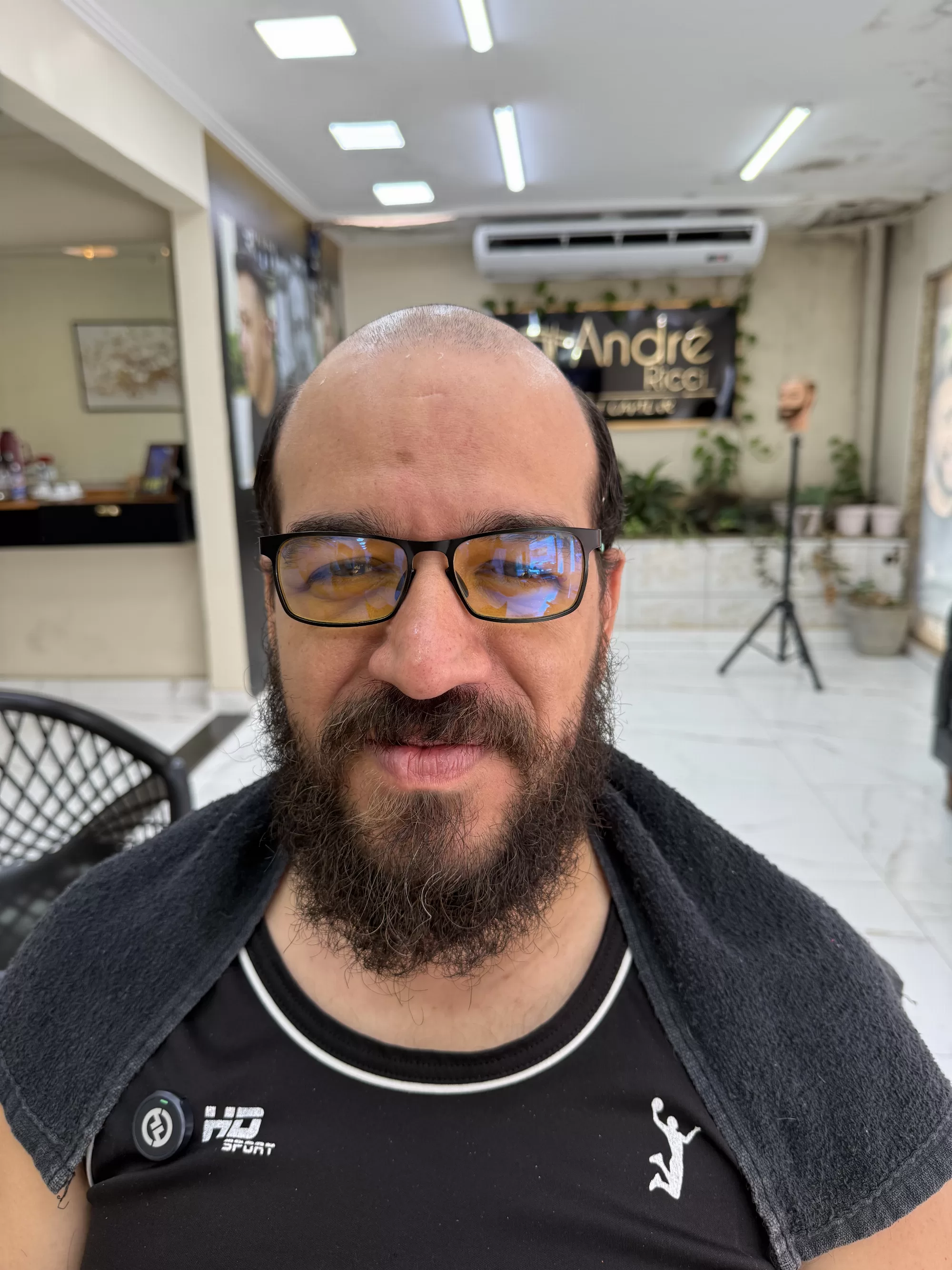 Antes — Estava careca no topo e saiu com o cabelo cheio e sorrindo: prótese capilar masculina com resultado natural, aqui no RJ.
