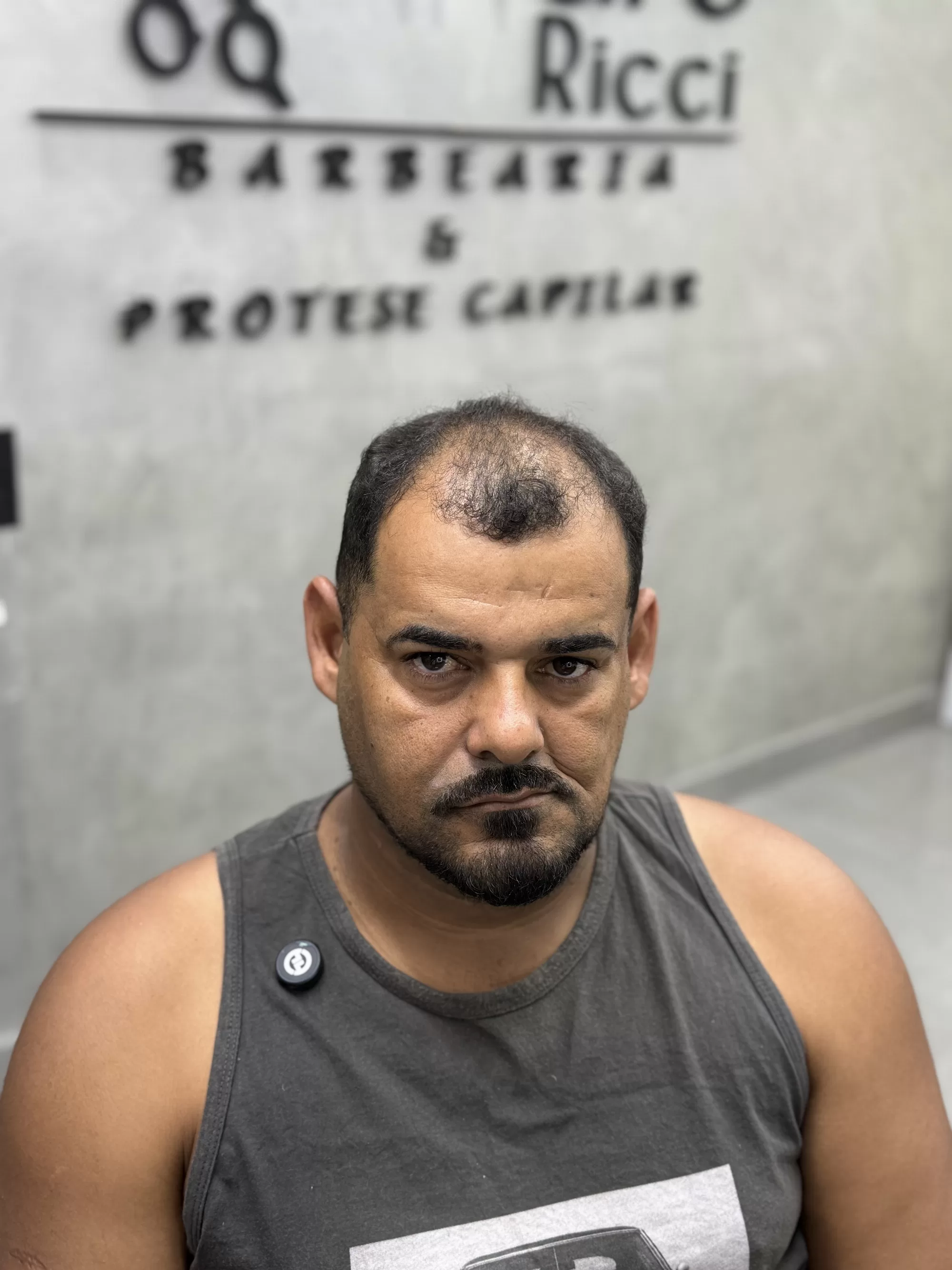 Antes — Tinha entradas fundas e ficou com o cabelo cheio de novo: prótese capilar masculina com visual jovem e natural, em Magé/RJ.